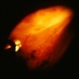 peripheral pre-retinal fibrosis and neovascularization with vitreous cutter